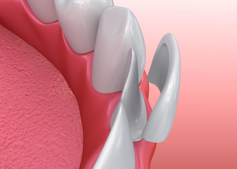 veneers3